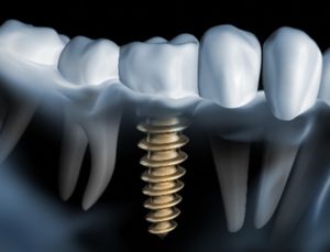 Blog Computer Guided Dental Implant Surgery at Dolan Dental
